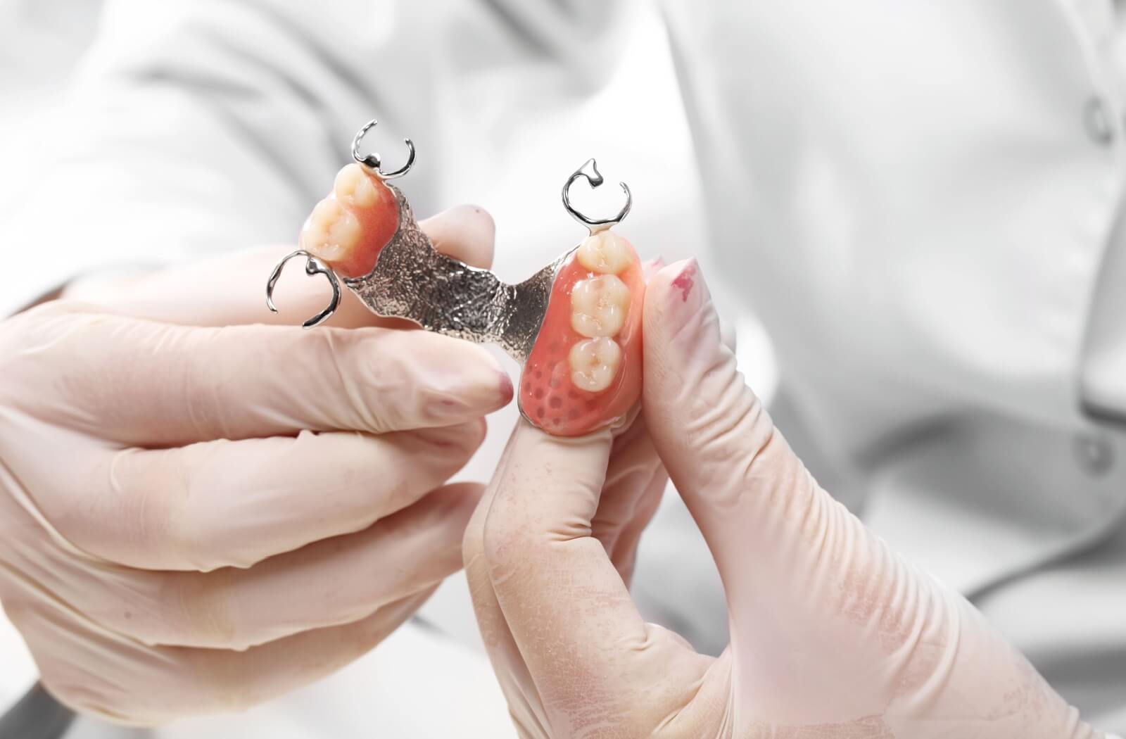 A dental professional wearing gloves holds a partial denture with a metal framework and replacement teeth, showing its structure and design.